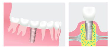 Dental implant