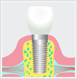 Image of dental implant